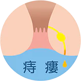 痔瘻