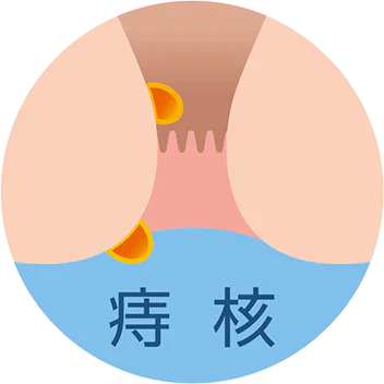 痔核
