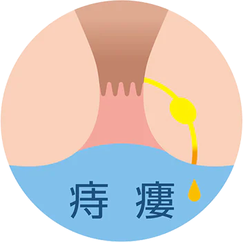 痔瘻