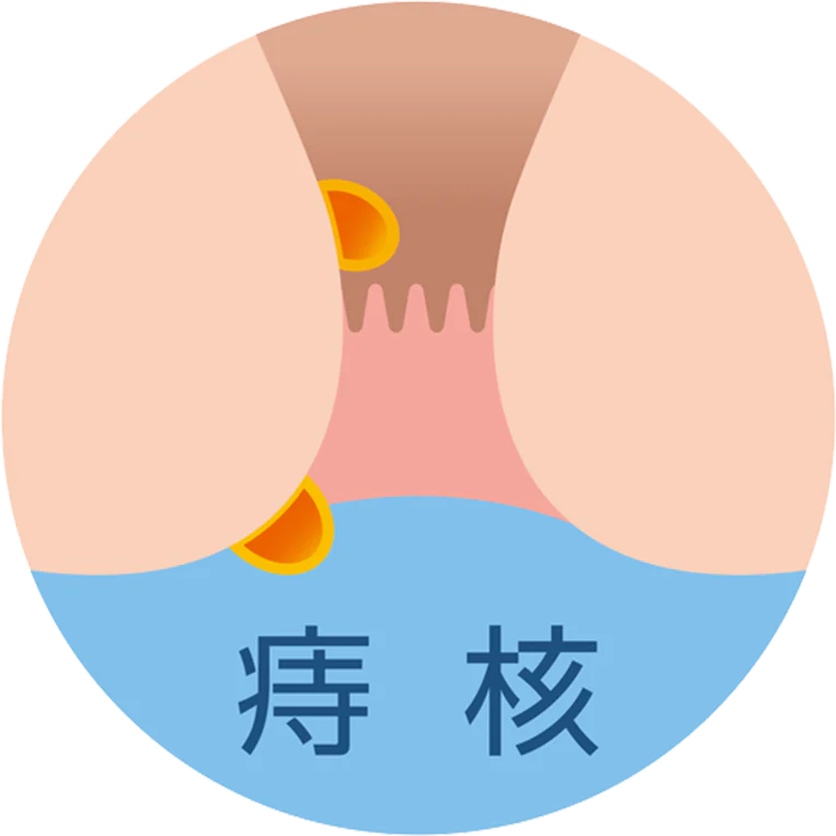 痔核