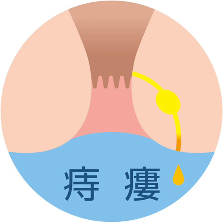 痔瘻